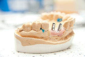 La pose d'implants dentaires